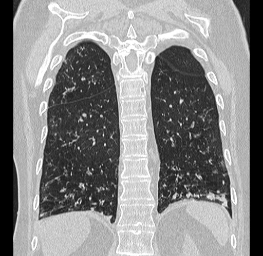 File:Alpha-1-antitrypsin deficiency (Radiopaedia 72058-82557 Coronal lung window 77).jpg