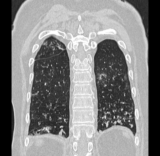 Alpha-1-antitrypsin deficiency (Radiopaedia 72058-82557 Coronal lung window 84).jpg
