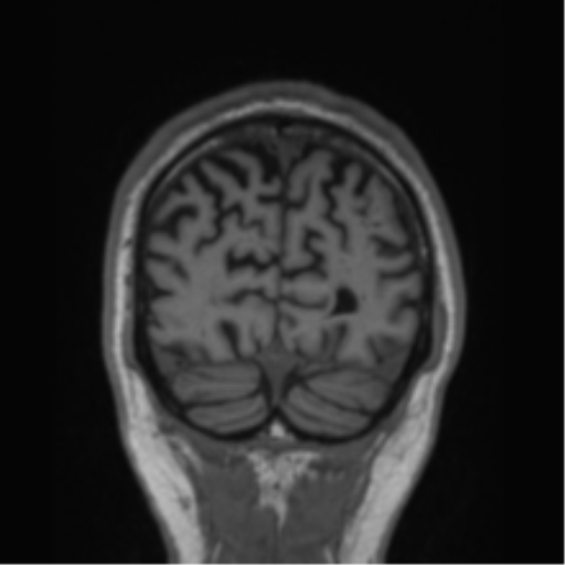 File:Alzheimer's disease- with Gerstmann syndrome and dressing apraxia (Radiopaedia 54882-61150 Coronal T1 15).png
