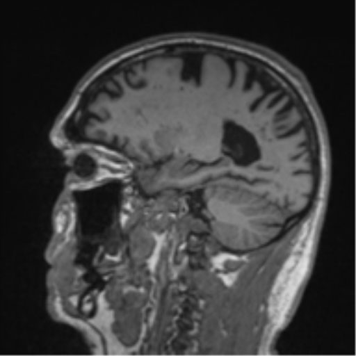 Alzheimer's disease- with Gerstmann syndrome and dressing apraxia (Radiopaedia 54882-61150 Sagittal T1 48).png