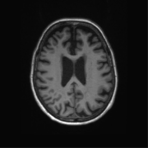 Alzheimer's disease (Radiopaedia 42658-45802 Axial T1 59).png