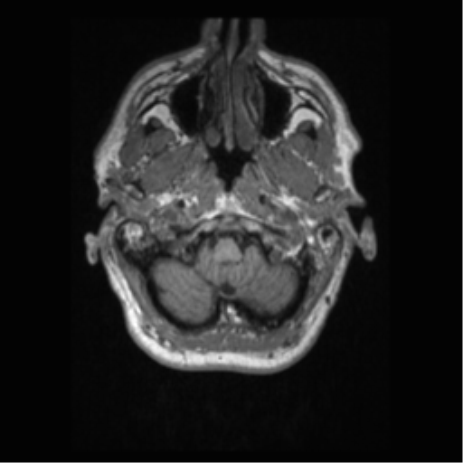 Alzheimer disease - probable (Radiopaedia 35334-36837 Axial T1 12).png