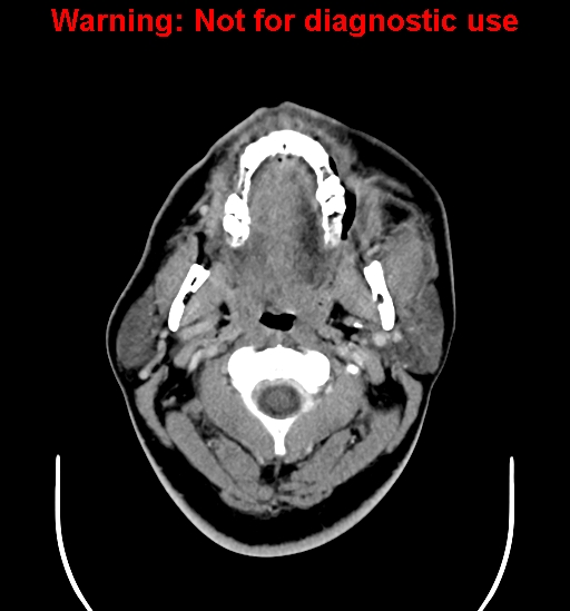 File:Ameloblastoma (Radiopaedia 33126-34164 B 3).jpg