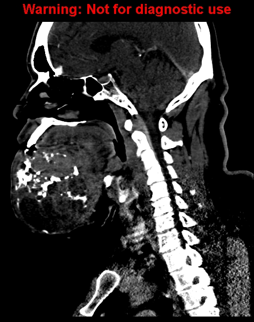 Ameloblastoma (Radiopaedia 33126-34164 F 35).jpg