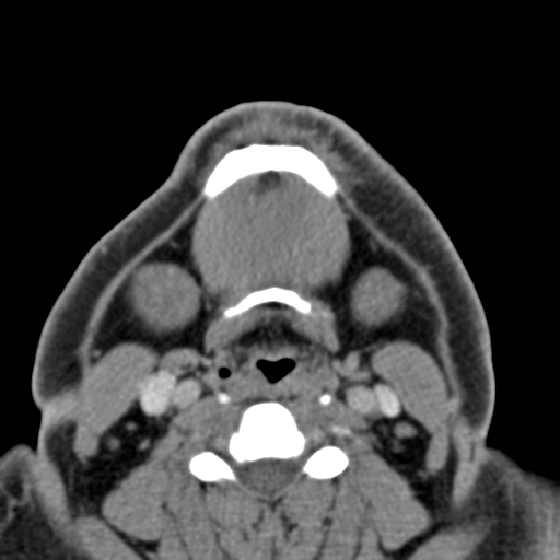 File:Ameloblastoma (Radiopaedia 33677-34806 Axial non-contrast 33).png