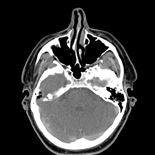 File:Ameloblastoma (Radiopaedia 38520-40623 Axial non-contrast 10).png
