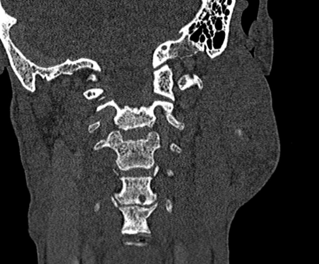 Ameloblastoma (Radiopaedia 51921-57766 Coronal bone window 238).jpg