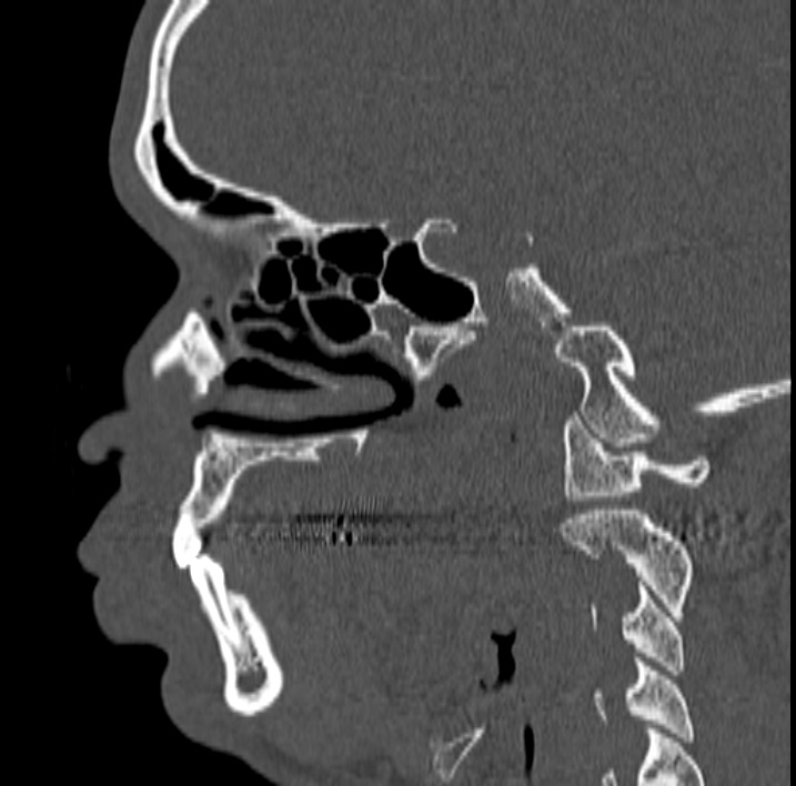 Ameloblastoma (Radiopaedia 77750-89997 Sagittal bone window 6).jpg