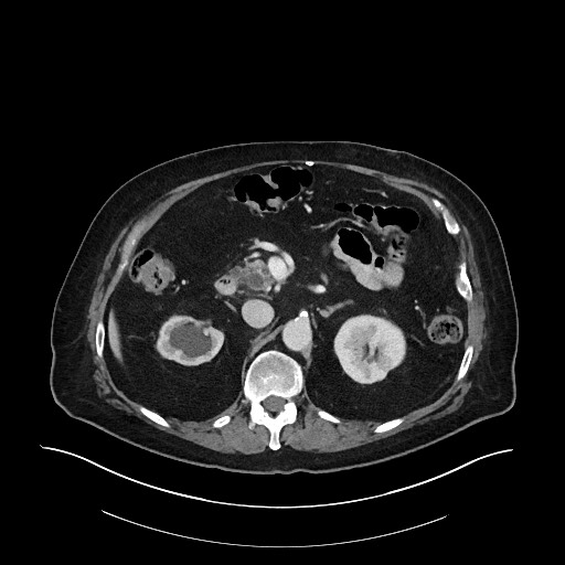 File:Ampullary adenocarcinoma (Radiopaedia 59373-66734 C 58).jpg