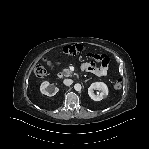 Ampullary adenocarcinoma (Radiopaedia 59373-66734 C 61).jpg