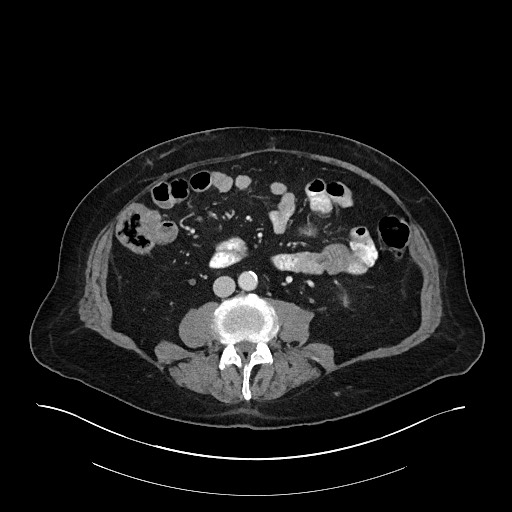 Ampullary adenocarcinoma (Radiopaedia 59373-66734 C 91).jpg