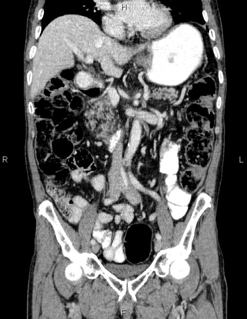 Ampullary adenocarcinoma (Radiopaedia 86093-102032 C 31).jpg