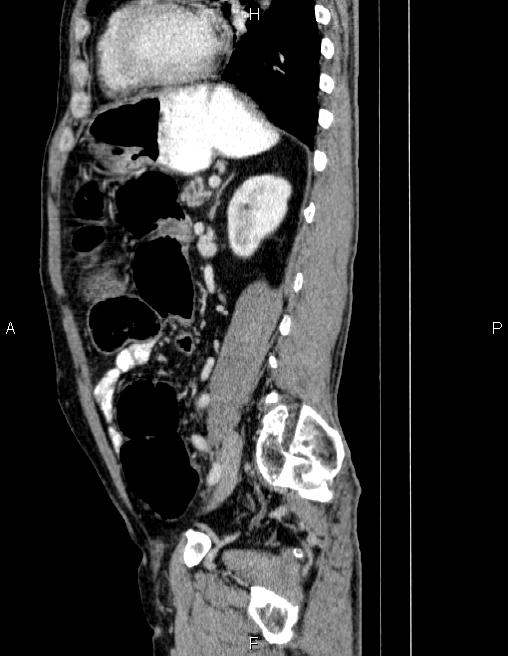 Ampullary adenocarcinoma (Radiopaedia 86093-102032 D 64).jpg