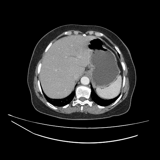 Ampullary tumor (Radiopaedia 60333-67998 A 9).jpg