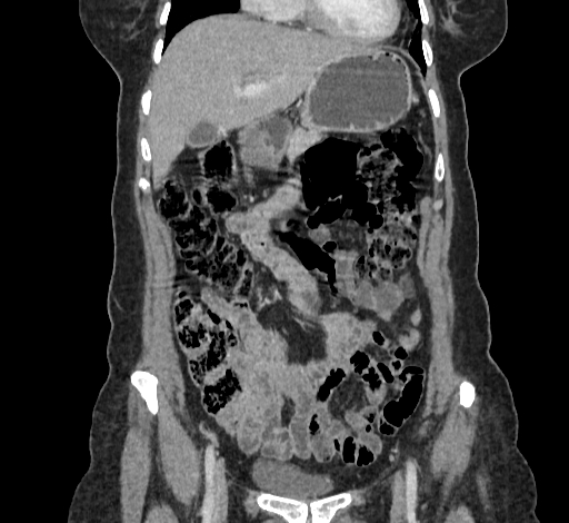 Ampullary tumor (Radiopaedia 60333-67998 B 22).jpg