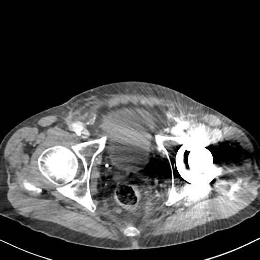 File:Amyand hernia (Radiopaedia 39300-41547 A 69).png
