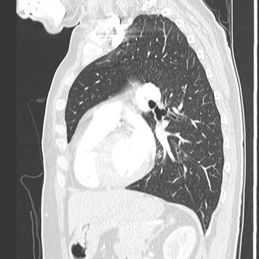 Amyloidosis - bronchial and diffuse nodular pulmonary involvement (Radiopaedia 60156-67745 Sagittal lung window 58).jpg