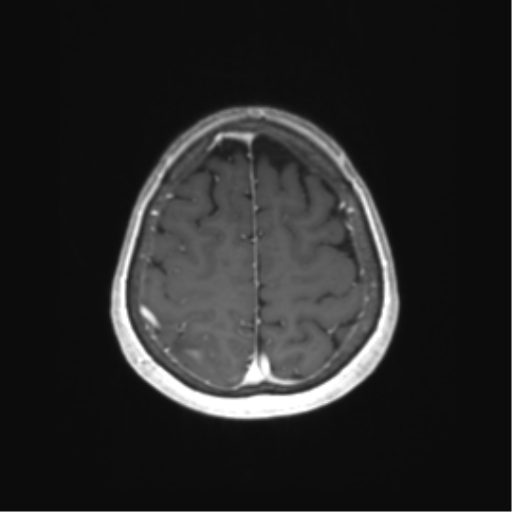 File:Anaplastic astrocytoma (Radiopaedia 86943-103160 Axial T1 C+ 71).png