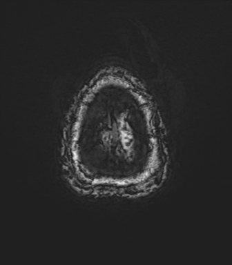 Anaplastic astrocytoma - thalamic glioma (Radiopaedia 59709-67115 G 86).png