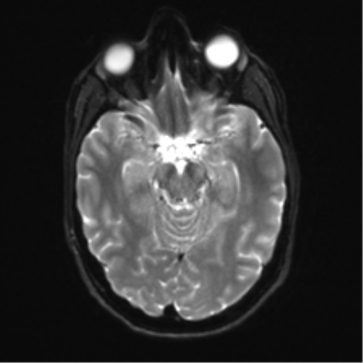 Anaplastic astrocytoma IDH mutant (Radiopaedia 50046-55341 Axial DWI 11).png
