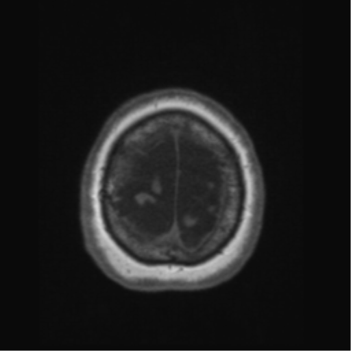 File:Anaplastic astrocytoma IDH wild-type (pseudoprogression) (Radiopaedia 42209-45276 Axial T1 138).png