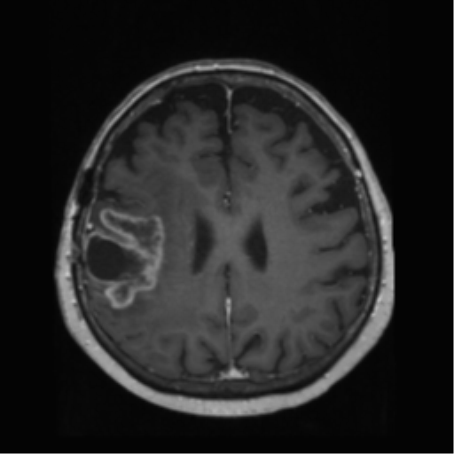 File:Anaplastic astrocytoma IDH wild-type (pseudoprogression) (Radiopaedia 42209-45278 Axial T1 C+ 103).png