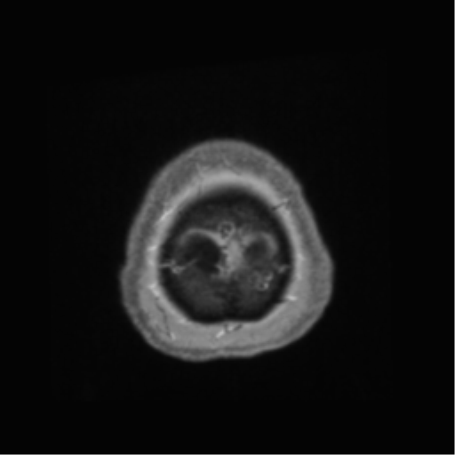 Anaplastic astrocytoma IDH wild-type (pseudoprogression) (Radiopaedia 42209-45278 Axial T1 C+ 148).png