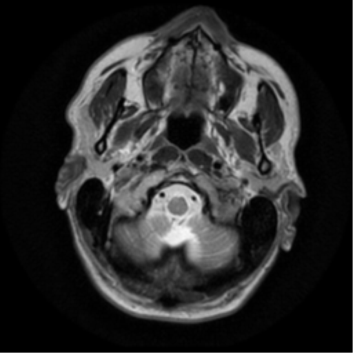File:Anaplastic meningioma with recurrence (Radiopaedia 34452-35790 Axial T2 2).png