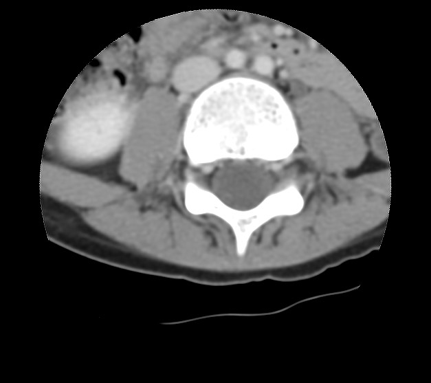 File:Aneurysmal bone cyst - sacrum (Radiopaedia 65190-74195 Axial non-contrast 2).jpg