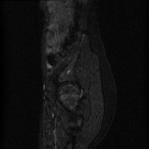 File:Aneurysmal bone cyst - sacrum (Radiopaedia 65190-74196 Sagittal STIR 29).jpg