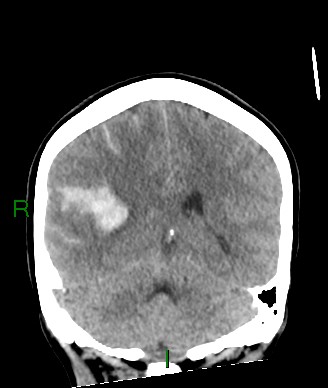 Aneurysmal subarachnoid hemorrhage with intra-axial extension (Radiopaedia 84371-99699 Coronal non-contrast 27).jpg
