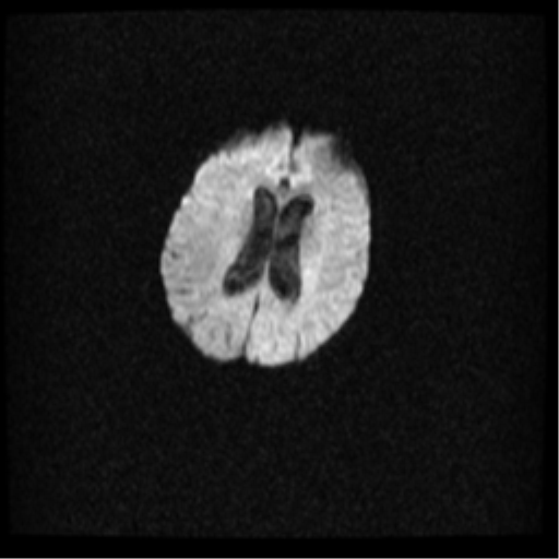 Angioinvasive aspergillosis in the pituitary fossa (Radiopaedia 39676-42010 Axial DWI 25).png