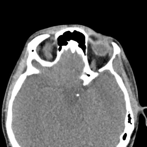 Angular dermoid cyst (Radiopaedia 88967-105790 Axial non-contrast 33).jpg