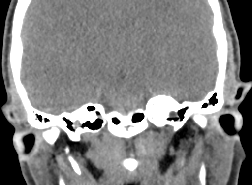Angular dermoid cyst (Radiopaedia 88967-105790 Coronal non-contrast 70).jpg
