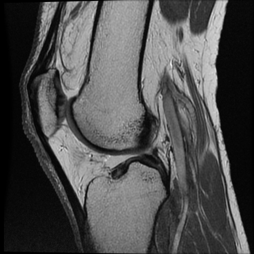 File:Anomalous insertion of the medial meniscus (Radiopaedia 77559-89721 Sagittal PD 24).jpg
