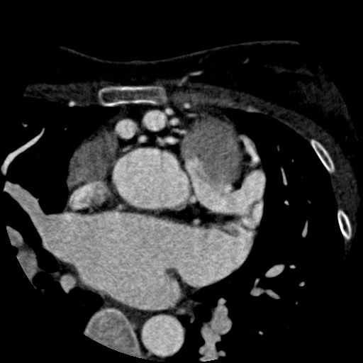 File:Anomalous left coronary artery from the pulmonary artery (ALCAPA) (Radiopaedia 40884-43586 A 17).jpg