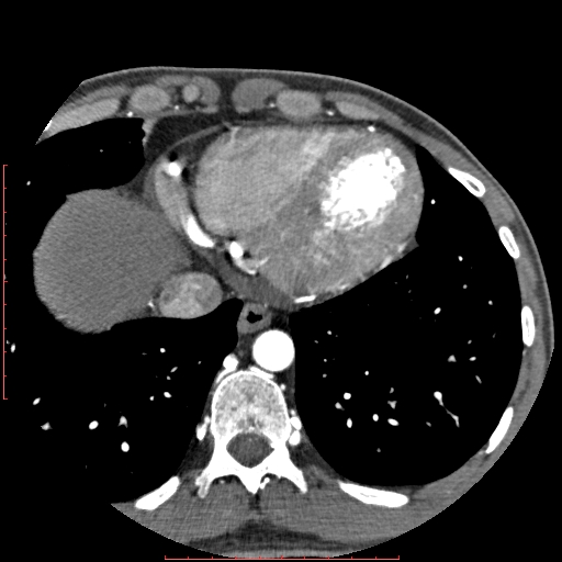 File:Anomalous left coronary artery from the pulmonary artery (ALCAPA) (Radiopaedia 70148-80181 A 317).jpg