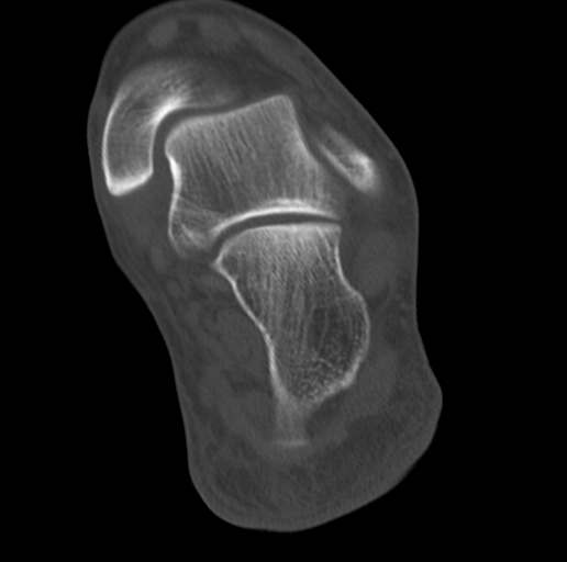 Anterior calcaneal process fracture (Radiopaedia 47384-51989 Coronal bone window 62).png