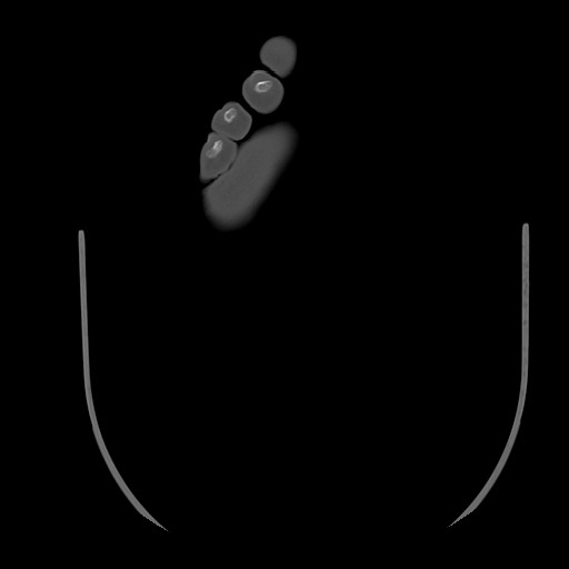 Anterior calcaneal process fracture (Radiopaedia 82590-96762 Axial bone window 50).jpg