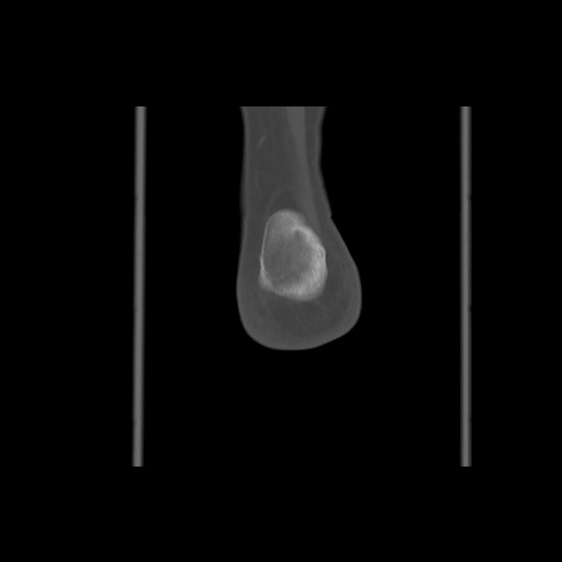 File:Anterior calcaneal process fracture (Radiopaedia 82590-96762 Coronal bone window 72).jpg