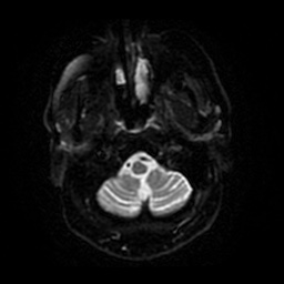 Anterior cerebral artery infarction (Radiopaedia 46794-51323 Axial DWI 31).jpg
