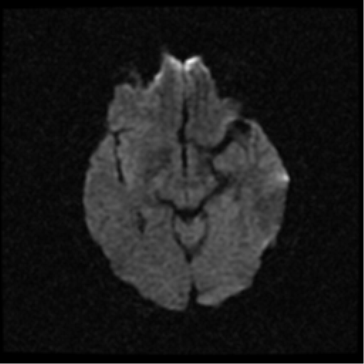 File:Anterior cerebral artery territory infarct (Radiopaedia 39327-41584 Axial DWI 11).png