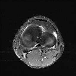 File:Anterior cruciate ligament full thickness tear (Radiopaedia 66268-75467 Axial PD fat sat 19).jpg