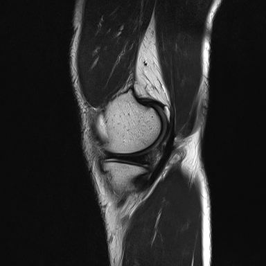 File:Anterior cruciate ligament full thickness tear (Radiopaedia 66268-75467 Sagittal T2 5).jpg