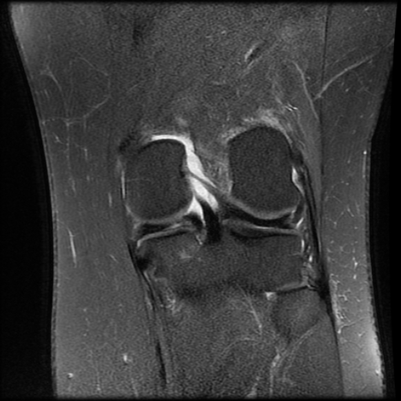 File:Anterior cruciate ligament tear, Wrisberg rip and bucket-handle tear of medial meniscus (Radiopaedia 75872-87266 Coronal PD fat sat 19).jpg
