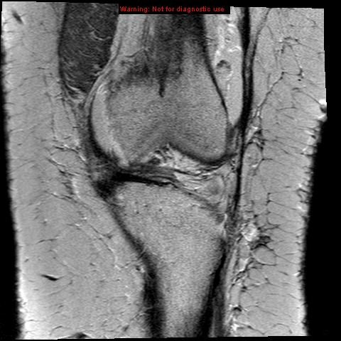 File:Anterior cruciate ligament tear (Radiopaedia 12329-12612 Coronal PD 4).jpg