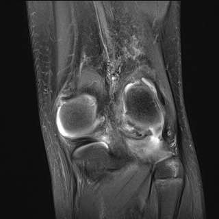 File:Anterior cruciate ligament tear - pediatric (Radiopaedia 62152-70260 Coronal PD fat sat 6).jpg
