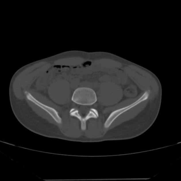 Anterior inferior iliac spine avulsion fracture (Radiopaedia 49469-54627 Axial bone window 1).jpg