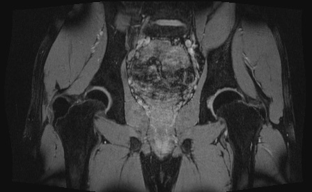 Anterior inferior iliac spine avulsion fracture (Radiopaedia 81312-95000 G 28).jpg