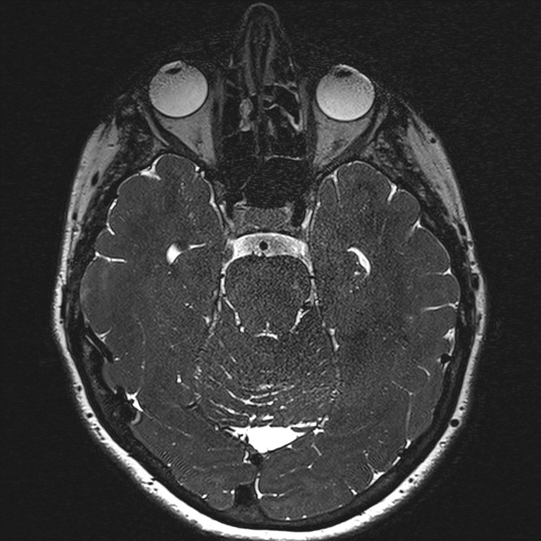 Anterior temporal encephalocele (Radiopaedia 82624-96808 Axial T2 high res 69).jpg